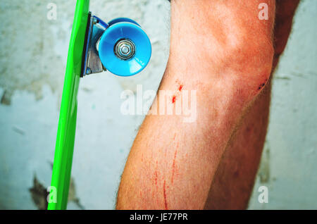 Uno skateboard close-up vicino al ferito giovane uomo della gamba. Di natura traumatica extreme sports concept Foto Stock