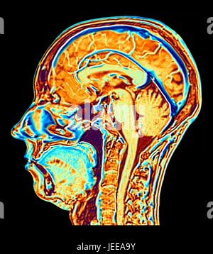 Computer enhanced falso colore di immagini a risonanza magnetica (MRI) di una metà sezione sagittale attraverso la testa di un normale 46 anno-vecchio donna, che illustra le strutture del cervello, la colonna vertebrale e i facciali. Funzioni di profilato della parte principale del cervello includono la superficie ondulata della corteccia cerebrale, il corpo calloso, pons & medulla, strutture del tronco cerebrale, che sono continue con il midollo spinale. Il cervelletto, il centro di equilibrio e coordinamento, si trova a destra del tronco cerebrale. Foto Stock