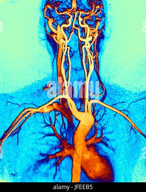 Torace, collo e testa le arterie. Colorato angiografia con risonanza magnetica (MRA) scansione di un normale sistema di carotide di 45 anno vecchio femmina. Centro Fondo è l'arco aortico, curve di cui sopra il cuore. Le arterie che si diramano da queste sono: l'arteria brachiocephalic (sinistra), l'arteria carotidea sinistra comune (centro) e l'arteria succlavia sinistra (a destra). L arteria brachiocephalic si divide nuovamente nel diritto comune e la carotide destra arteria succlavia. La destra e la sinistra arterie carotidi comuni alimentazione del collo e la destra e sinistra arteria succlavia di fornire le armi. MRA è un non-invasiva Foto Stock