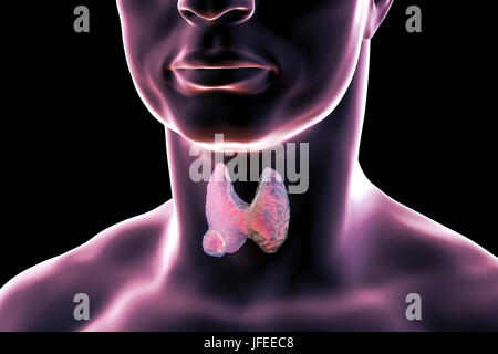 Ghiandola tiroide tumore, illustrazione del computer. Foto Stock
