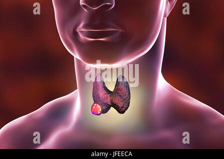 Ghiandola tiroide tumore, illustrazione del computer. Foto Stock