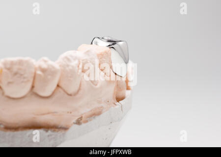 Artificiale di acciaio la corona dentale per la dentizione restauro Foto Stock