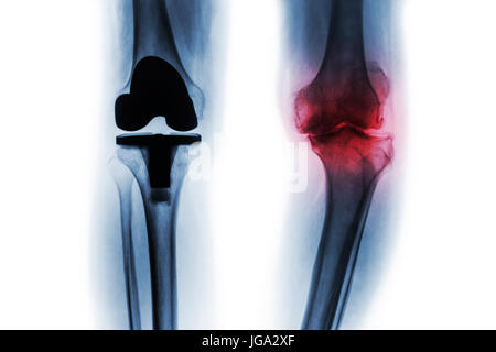 Film x-ray di osteoartrite del ginocchio e paziente articolazione artificiale ( sostituzione totale del ginocchio ) . Sfondo isolata . Foto Stock