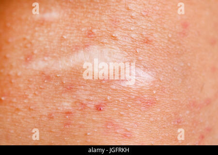 Immagine ravvicinata della ferita al ginocchio femminile, pelle irritata dopo la depilazione Foto Stock