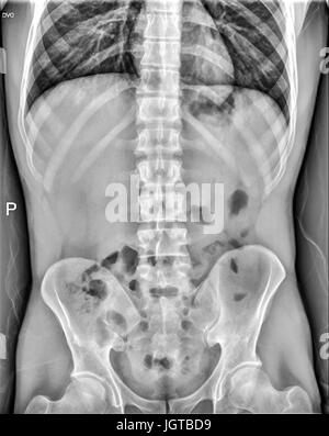 Addome medical xray, polmoni, cuore, rig gabbia, osso pelvico, midollo spinale e degli organi interni Foto Stock