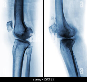 Confronto tra ginocchio umano normale ( immagine a sinistra ) e osteoartrite del ginocchio destro ( immagine ) . Vista laterale . Foto Stock