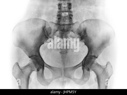 Film x-ray di normale umano del bacino e articolazioni dell'anca . Foto Stock