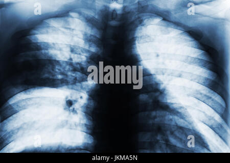 Lobar polmonite . Torace Film x-ray show lacunose infiltrarsi a medio destro del polmone da infezione da Mycobacterium tuberculosis ( tubercolosi polmonare ) . Foto Stock