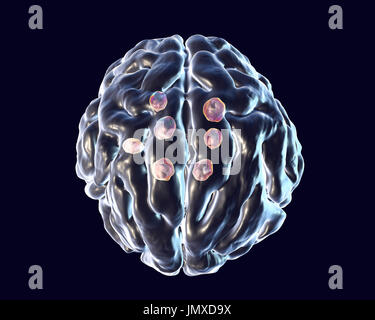 Da criptococco lesioni cerebrali. Illustrazione di una molteplicità di parenchima cerebrale lesioni causate dal fungo Cryptococcus neoformans. C. neoformans è un lievito-come organismo. Cryptococcosis è una rara infezione che colpisce le persone con una deficienza del sistema immunitario come nell'AIDS (sindrome da immunodeficienza acquisita). Esso è causato da inalare il fungo trovato in suolo contaminato da escrementi di piccione. Le infezioni possono causare meningiti o singolo o lesioni multiple nel parenchima cerebrale. Cryptococcus neoformans var. gattii più comunemente produce lesioni parenchima mentre Cryptococcus neoformans var. neoformans Foto Stock