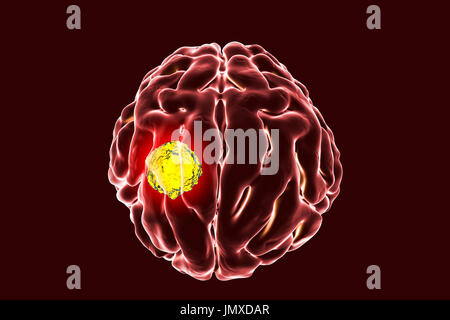 Brain cancer, computer grafica. Foto Stock