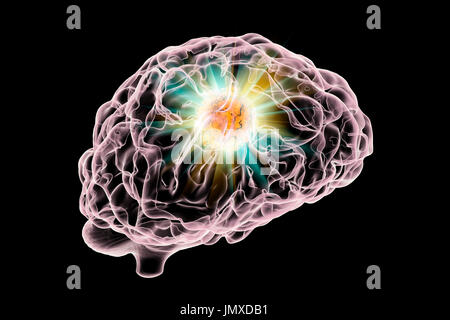 Immagine concettuale per il cancro al cervello di trattamento. Computer illustrazione mostrante la distruzione del tumore al cervello. Foto Stock