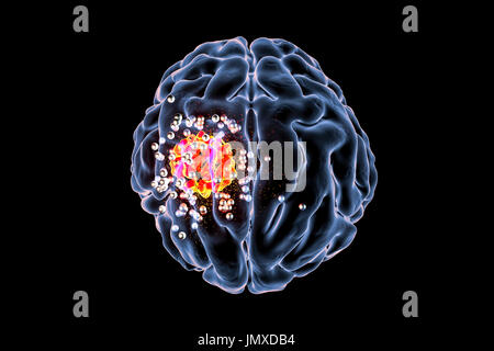 Immagine concettuale per il cancro al cervello il trattamento con la nanotecnologia. Computer illustrazione mostrante la distruzione del tumore al cervello da nanoparticelle. Foto Stock