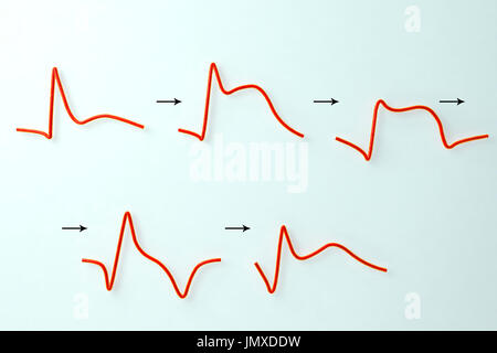 Evoluzione di un elettrocardiogramma (ECG) durante un infarto del miocardio (attacco cardiaco). Computer illustrazione che mostra il sopraslivellamento del tratto ST e onda Q, formazione di inversione dell'onda T e la normalizzazione con una persistente onda Q. Foto Stock