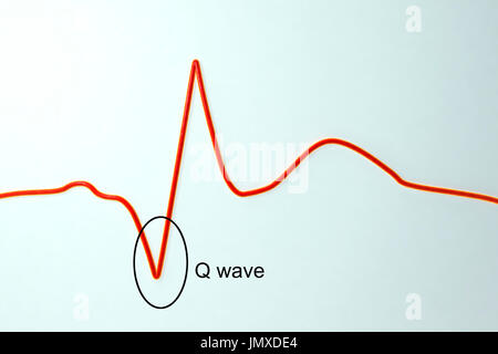 Elettrocardiogramma (ECG) durante un infarto del miocardio (attacco cardiaco). Computer illustrazione che mostra la formazione di patologica onda Q. Foto Stock