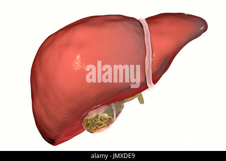 Calcoli biliari. Illustrazione che mostra del fegato e della cistifellea con calcoli biliari. La cistifellea memorizza la bile, il fluido digestivo che viene prodotta dal fegato (al di sopra della cistifellea) e passate per il piccolo intestino. I calcoli biliari, hard depositi formatisi di colesterolo e di sali biliari, formano nella cistifellea quando vi è uno squilibrio nella composizione chimica della bile. I calcoli biliari sono di solito symptomless, a meno che uno non ostruisce il condotto biliare, causando dolore acuto, ittero e infezione. Il trattamento con farmaci per sciogliere le pietre o la rimozione chirurgica della cistifellea. Foto Stock