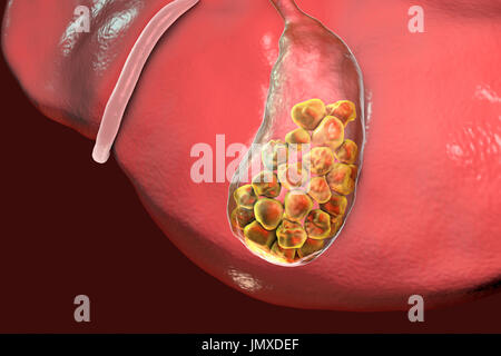 Calcoli biliari. Illustrazione che mostra del fegato e della cistifellea con calcoli biliari. La cistifellea memorizza la bile, il fluido digestivo che viene prodotta dal fegato (al di sopra della cistifellea) e passate per il piccolo intestino. I calcoli biliari, hard depositi formatisi di colesterolo e di sali biliari, formano nella cistifellea quando vi è uno squilibrio nella composizione chimica della bile. I calcoli biliari sono di solito symptomless, a meno che uno non ostruisce il condotto biliare, causando dolore acuto, ittero e infezione. Il trattamento con farmaci per sciogliere le pietre o la rimozione chirurgica della cistifellea. Foto Stock
