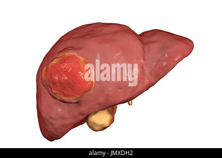 Il cancro al fegato, illustrazione del computer. Foto Stock