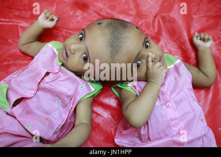 Dacca in Bangladesh. 29 Luglio, 2017. I congiunti del Bangladesh figlie gemelle Rabeya e Rokeya giaceva sul letto di ospedale a Dhaka, nel Bangladesh, 29 luglio 2017. Credito: Suvra Kanti Das/ZUMA filo/Alamy Live News Foto Stock