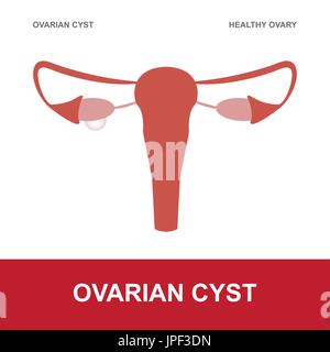 Illustrazione vettoriale di cisti ovarica e ovaio sano Illustrazione Vettoriale