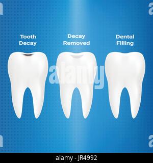 Il trattamento della carie. Riempimento dentale isolata su uno sfondo. Illustrazione Vettoriale. Illustrazione Vettoriale