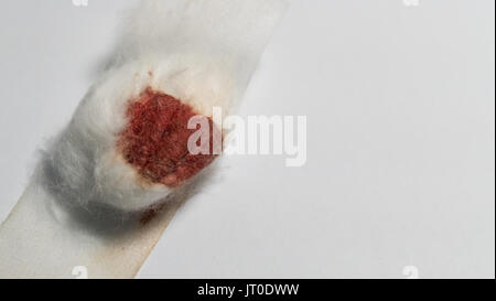 Sangue umano su cotone Lana palla di spugna su sfondo bianco. I prelievi di sangue o di donazione, servizio medico, health check up, concetto di emostasi Foto Stock