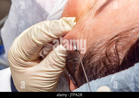 Il dermatologo chirurgo inserisce acido polilattico filamenti per eseguire il sollevamento del viso - messa a fuoco selettiva Foto Stock