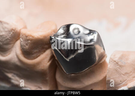 Artificiale di acciaio la corona dentale per la dentizione restauro Foto Stock