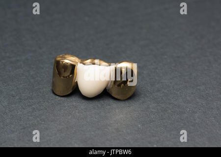 Artificiale di acciaio la corona dentale per la dentizione restauro Foto Stock