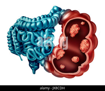 Il cancro del colon nozione come un intestino umano malattia con prospettiva forzata con microscopiche di tumore maligno all'interno dell'anatomia umana. Foto Stock