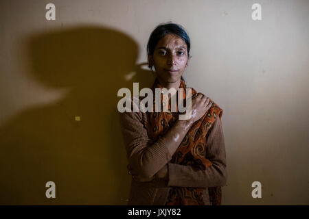 India, Calcutta, donne vittime attacco acido, ritratto Foto Stock