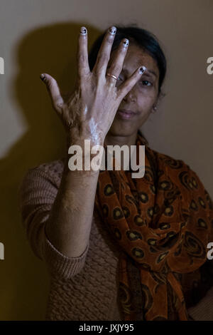 India, Calcutta, donne vittime attacco acido, ritratto Foto Stock