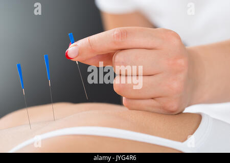 Close-up del terapista mettendo le mani degli aghi di agopuntura sulla donna di Back Foto Stock