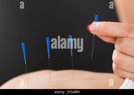 Close-up del terapista mettendo le mani degli aghi di agopuntura sulla donna di Back Foto Stock