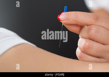 Close-up del terapista mettendo le mani degli aghi di agopuntura sulla donna di Back Foto Stock