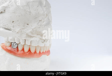 Dente artificiale, protesi dentaria con falso dente d'argento, metalic corona sul dente. Dentiera Foto Stock