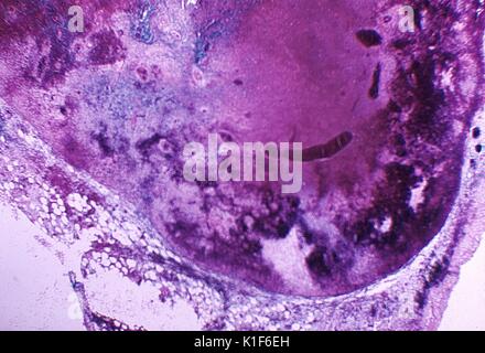 Grave necrosi emorragica del linfonodo dovuta all'antrace. Fotomicrografia del linfonodo mediastinico di una scimmia Cynomolgus, Macaca fascicularis, con antrace per inalazione, che dimostra grave necrosi emorragica. Colorante Giemsa, Mag. 20 volte. Immagine gentilmente concessa da CDC/Dr Ken Roberts, 1971. Foto Stock