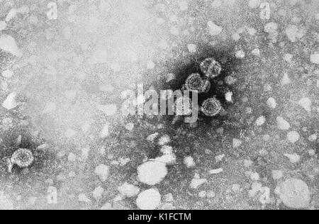 Questo microscopio elettronico a trasmissione (TEM) ha rivelato la presenza di infezione da epatite B virioni. La grande round virioni sono noti come particelle Dane. Vedere PHIL 10755, per una versione colorato di questa immagine. Epatite significa infiammazione del fegato. Le tossine, alcuni farmaci, alcune malattie, pesante uso di alcool e di infezioni batteriche e virali possono tutti causare epatite. Epatite è anche il nome di una famiglia di infezioni virali che colpiscono il fegato, la maggior parte dei tipi più comuni negli Stati Uniti sono epatite A, epatite B ed epatite C. Immagine cortesia CDC/Dott. Erskine Palmer, 1981. Foto Stock