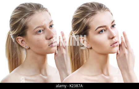 Ragazza con acne prima e dopo il trattamento Foto Stock