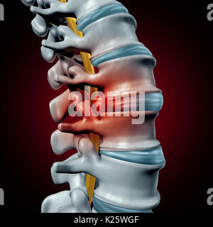 Human ernia del disco del concetto e il dolore della colonna vertebrale diagnostico come una colonna vertebrale umana simbolo del sistema come medico problema sanitario e simbolo di anatomia. Foto Stock