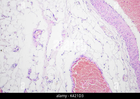 Il cancro del colon fotografia microscopica, ingrandimento x100 Foto Stock