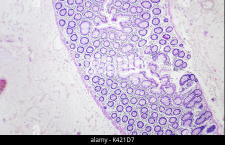 Il cancro del colon fotografia microscopica, ingrandimento x40 Foto Stock