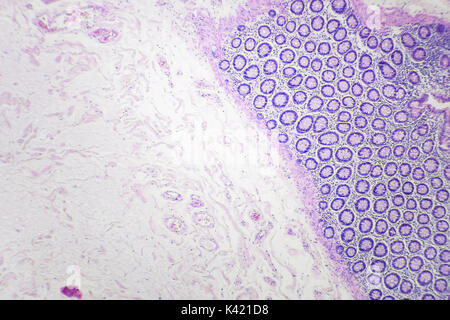 Il cancro del colon fotografia microscopica, ingrandimento x40 Foto Stock