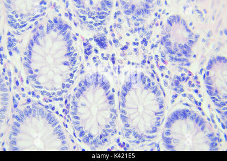 Il cancro del colon fotografia microscopica, ingrandimento x400 Foto Stock