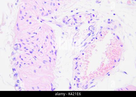 Il cancro del colon fotografia microscopica, ingrandimento x400 Foto Stock