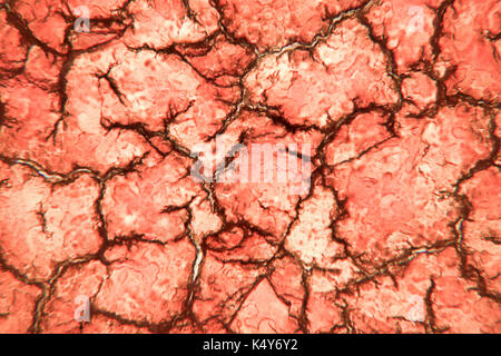 È solidificato del sangue coagulato visto su un 100x Microscopio Vista. striscio di sangue al microscopio presente di neutrofili e cellule di sangue rosse Foto Stock