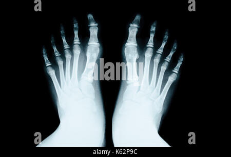 X-ray del piede umano sul nero. Foto Stock