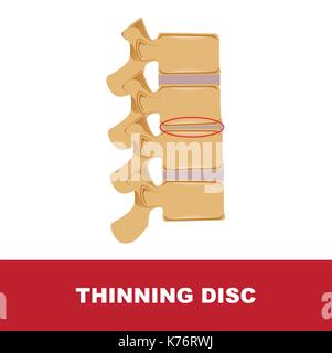 Uomo di degenerazione del disco. la degenerazione con disco di assottigliamento Illustrazione Vettoriale