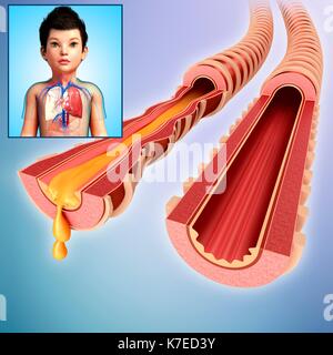 Illustrazione di un bambino e infetta il normale dei bronchi. Foto Stock