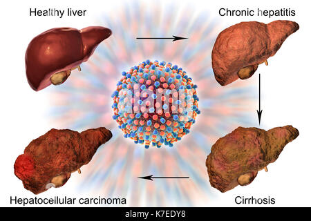 Il fegato umano che mostra fasi di malattia del fegato e un virus di epatite, illustrazione del computer. Foto Stock