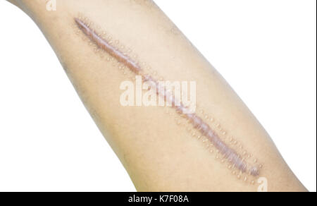Cicatrice keloid closeup sulla pelle dell'uomo asiatico dopo frattura del femore, coscia rotta su sfondo bianco con spazio di copia. Foto Stock